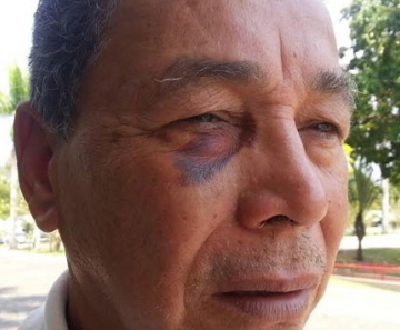 Juraci Lopes Cavalcante, de 69 anos, mostra o olho machucado após agressão em ônibus no DF 