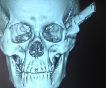 Em tomografria é possível ver a faca cravada no crânio do homem 