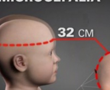 Bebê com circunferência do crânio menor que 32 cm é considerado portador de microcefalia.