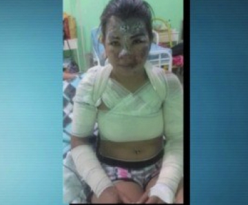Jovem foi queimada pelo marido em Tangará da Serra (MT)