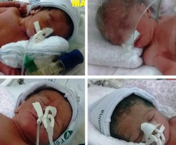 Quadrigêmeos nasceram em hospital de Cuiabá