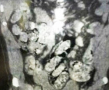 Raio-X mostra cápsulas de cocaína no estômago do boliviano que foi detido em Cáceres