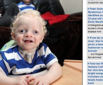 Menino albino e cego de 1 ano de idade sofre de uma síndrome genética 