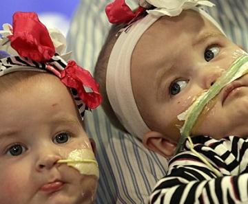 Alisson e Amelia aparecem em público pelas primeira vez após cirurgia de separação 