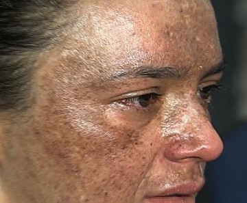 Mulher tem rosto queimado em tratamento