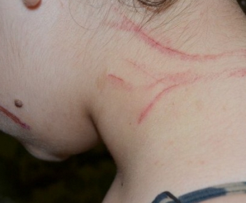 Garota de 12 anos ficou com ferimentos nas costas e no rosto após agressão 