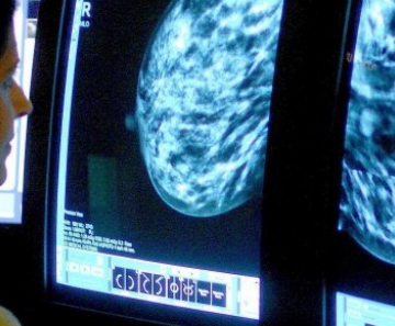 Entidades que combatem câncer de mama não recomendam uso de estatina e pedem mais estudos 