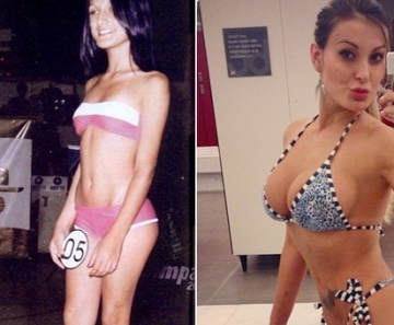 Andressa Urach antes e depois da fama - e das intervenções cirúrgicas estéticas 