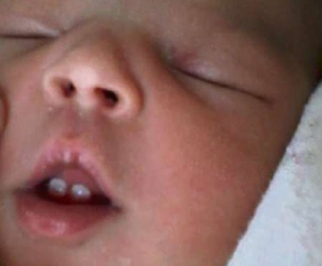 Bebê nasce com dois dentes em Colatina, Espírito Santo 