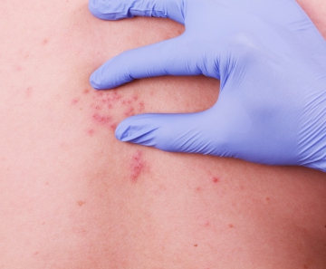 herpeszoster