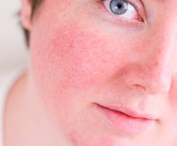 rosacea