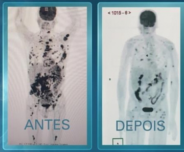 Técnica pioneira contra câncer vai estar no SUS? Saiba como 4 novos pacientes serão decisivos no estudo
